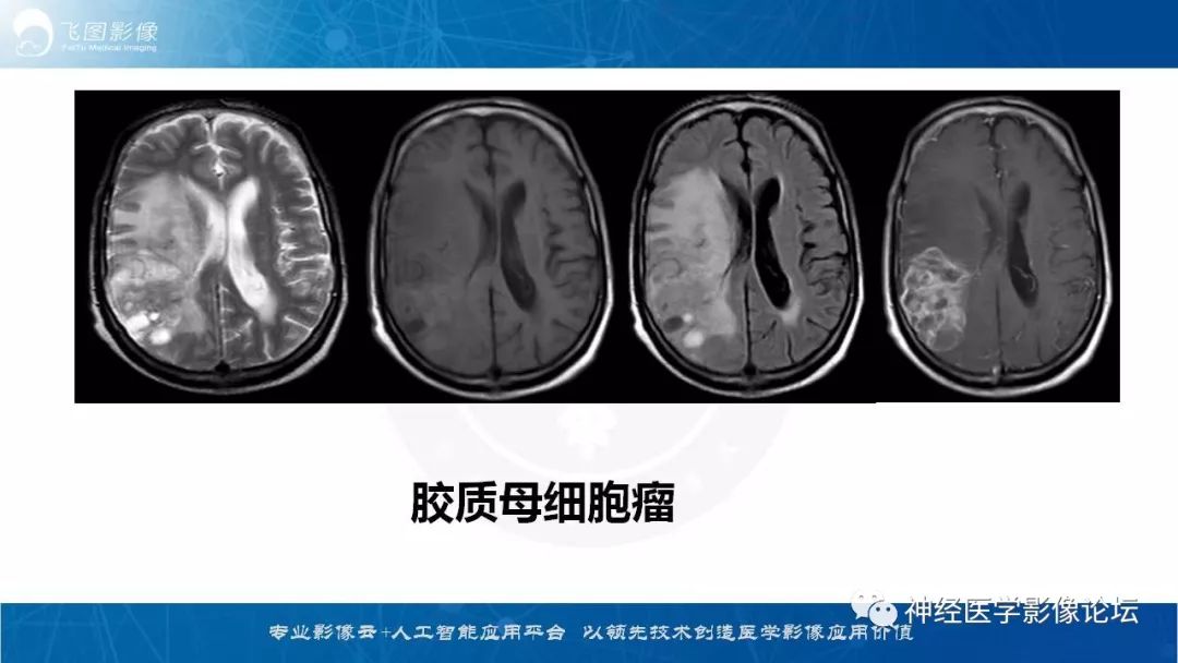 【病例】脑实质内室管膜瘤1例CT及MR影像表现