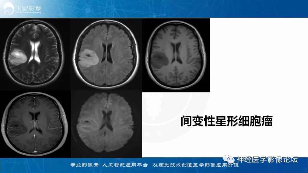 【病例】脑实质内室管膜瘤1例CT及MR影像表现