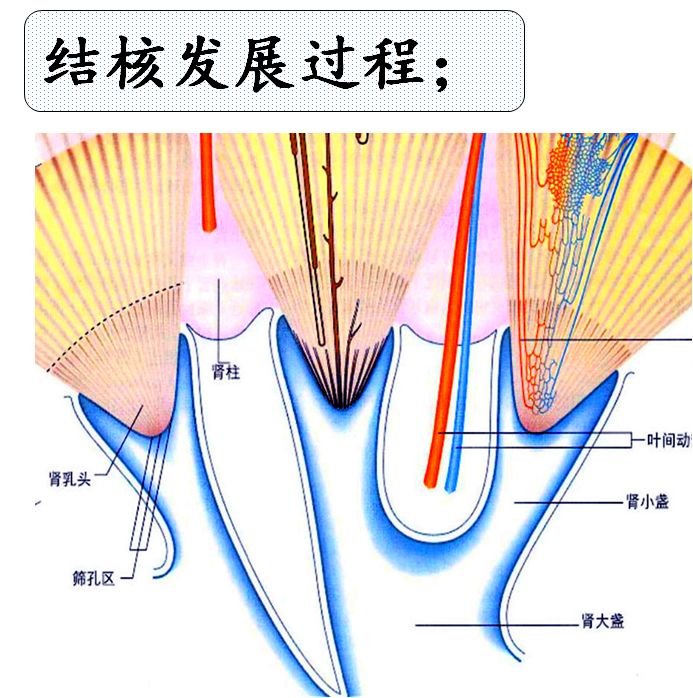 【PPT】肾脏炎性肉芽肿样病变影像表现