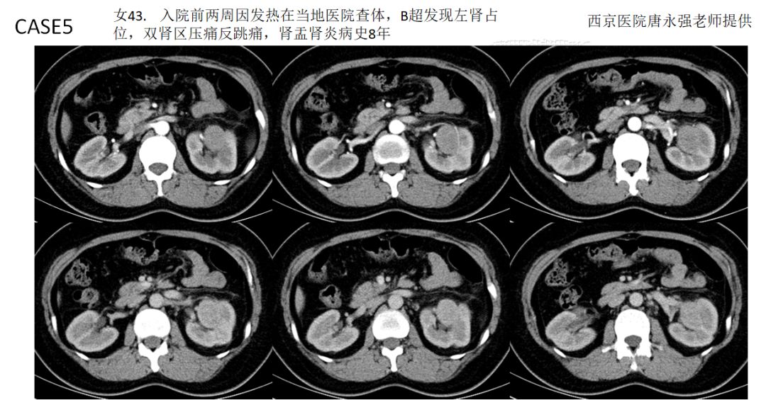 【PPT】肾脏炎性肉芽肿样病变影像表现
