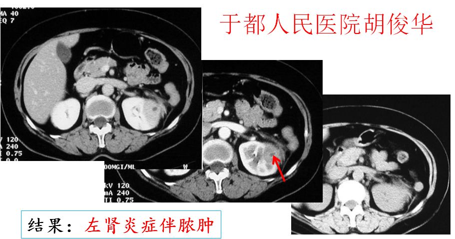 【PPT】肾脏炎性肉芽肿样病变影像表现