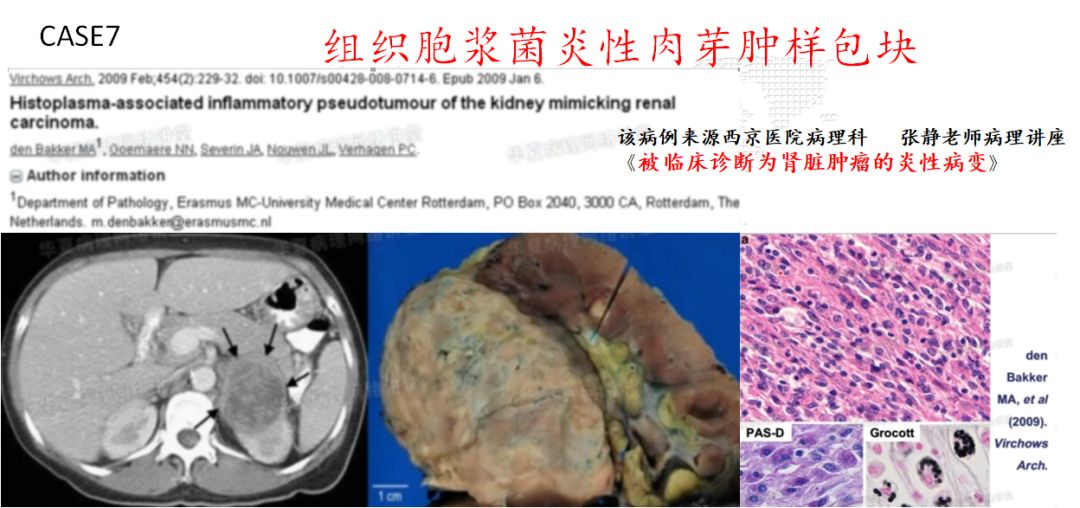 【PPT】肾脏炎性肉芽肿样病变影像表现
