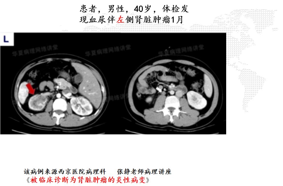 【PPT】肾脏炎性肉芽肿样病变影像表现