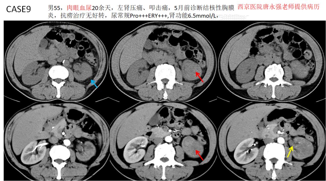 【PPT】肾脏炎性肉芽肿样病变影像表现