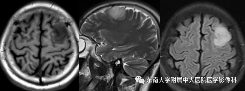 【病例】胚胎发育不良性神经上皮瘤1例MR