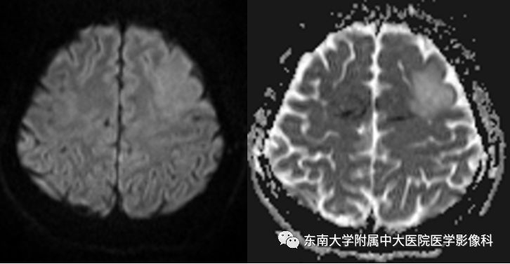 【病例】胚胎发育不良性神经上皮瘤1例MR