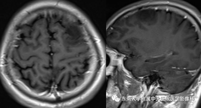 【病例】胚胎发育不良性神经上皮瘤1例MR