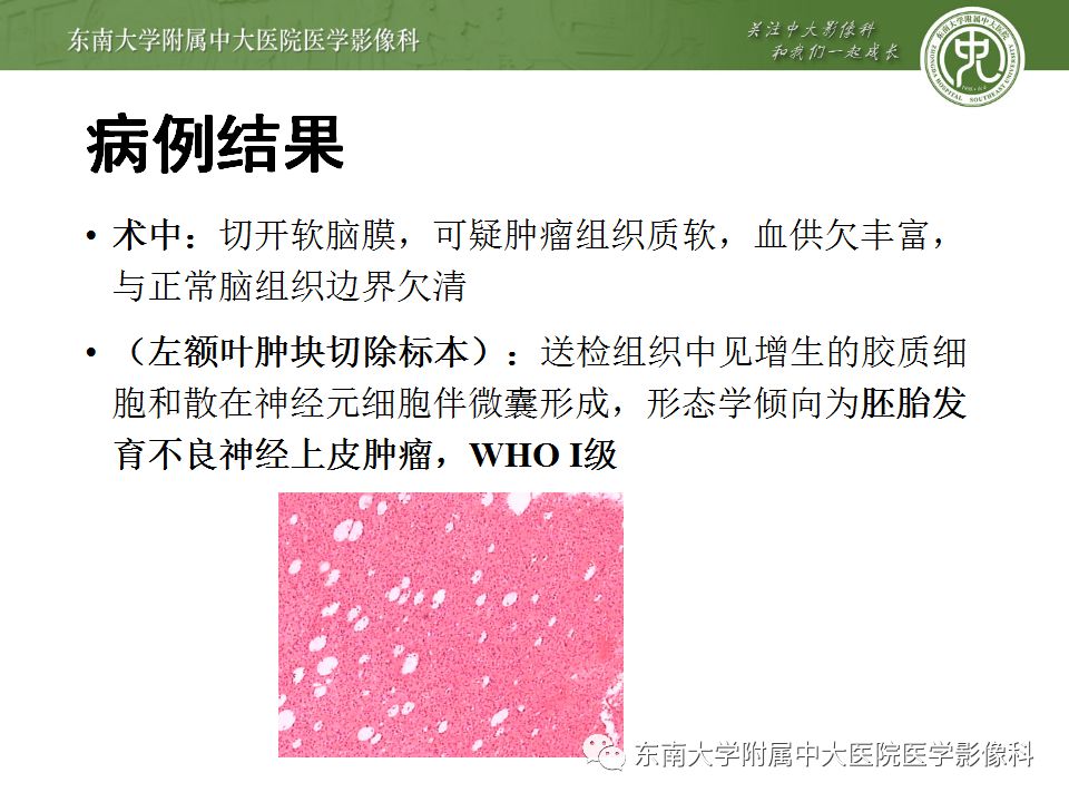 【病例】胚胎发育不良性神经上皮瘤1例MR