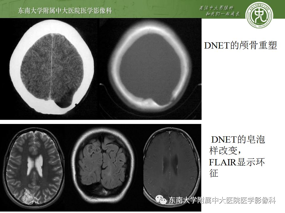 【病例】胚胎发育不良性神经上皮瘤1例MR