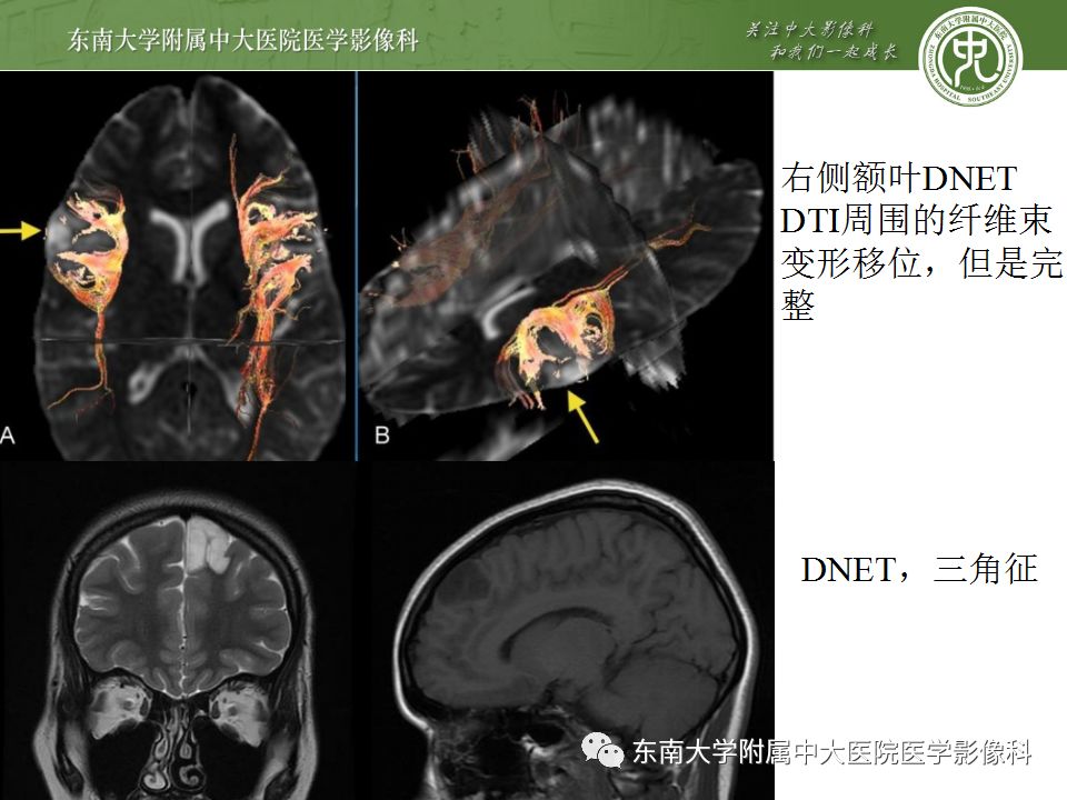 【病例】胚胎发育不良性神经上皮瘤1例MR