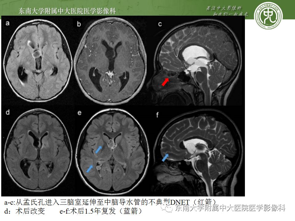 【病例】胚胎发育不良性神经上皮瘤1例MR