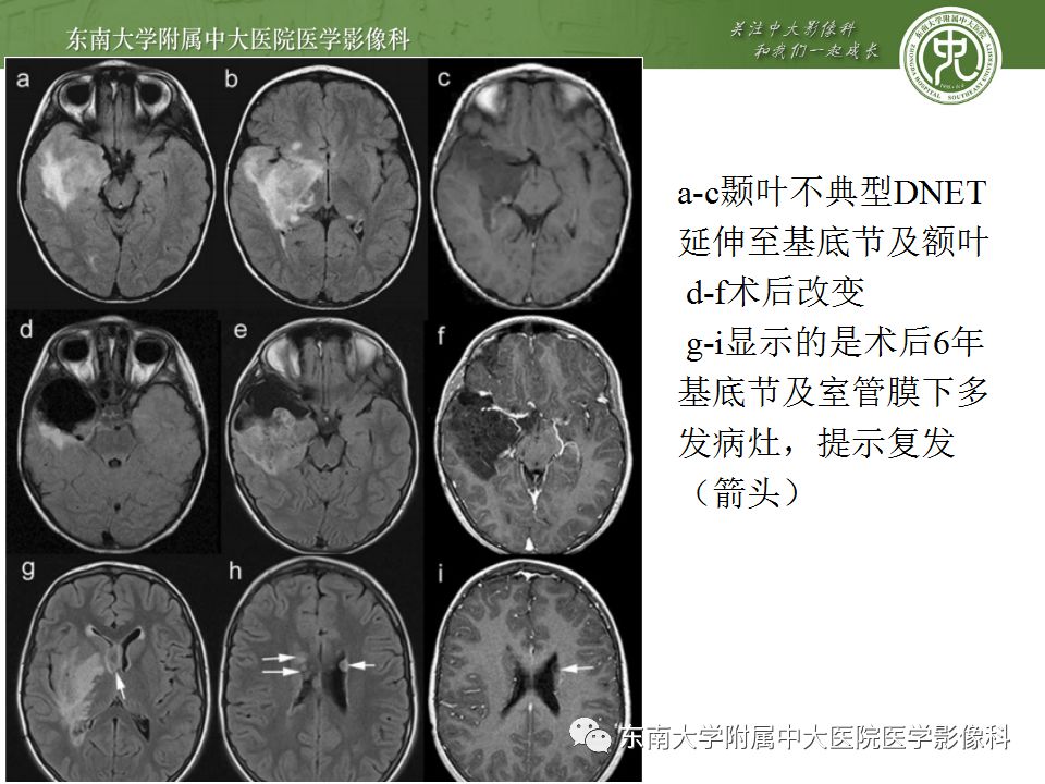 【病例】胚胎发育不良性神经上皮瘤1例MR