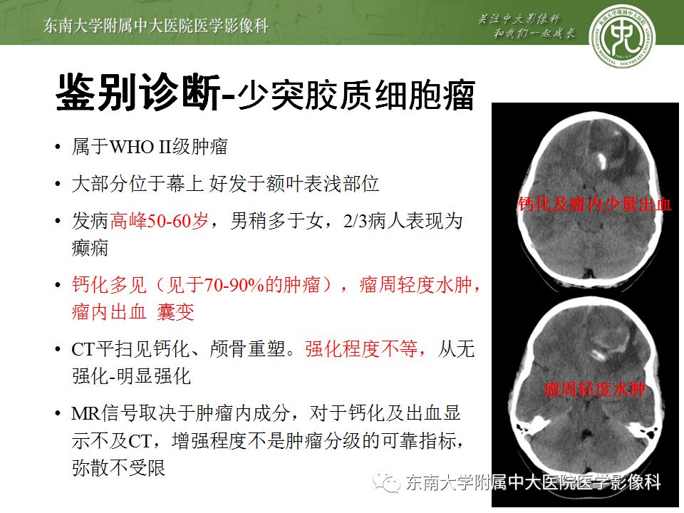 【病例】胚胎发育不良性神经上皮瘤1例MR