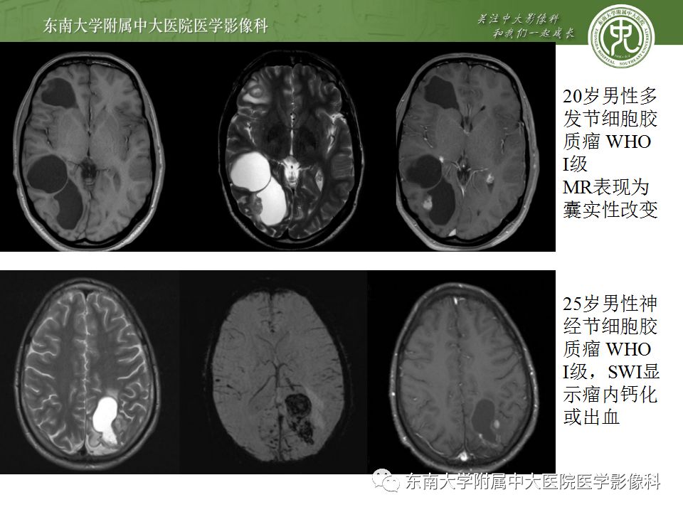 【病例】胚胎发育不良性神经上皮瘤1例MR