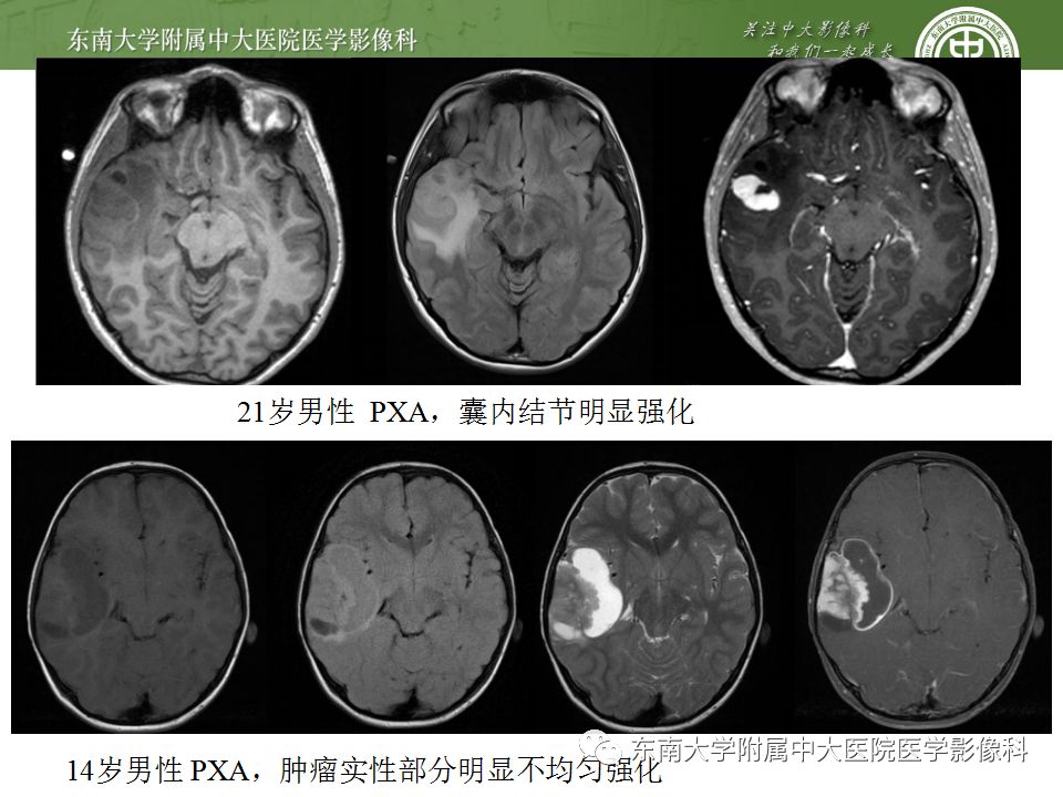 【病例】胚胎发育不良性神经上皮瘤1例MR