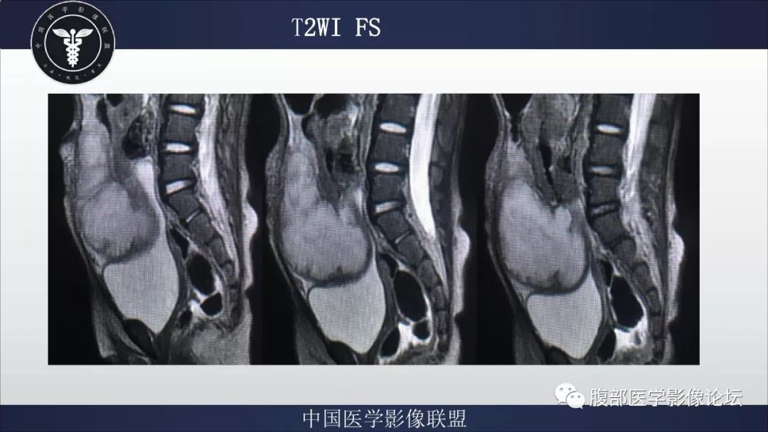 【病例】脐尿管囊肿并感染1例MR影像表现