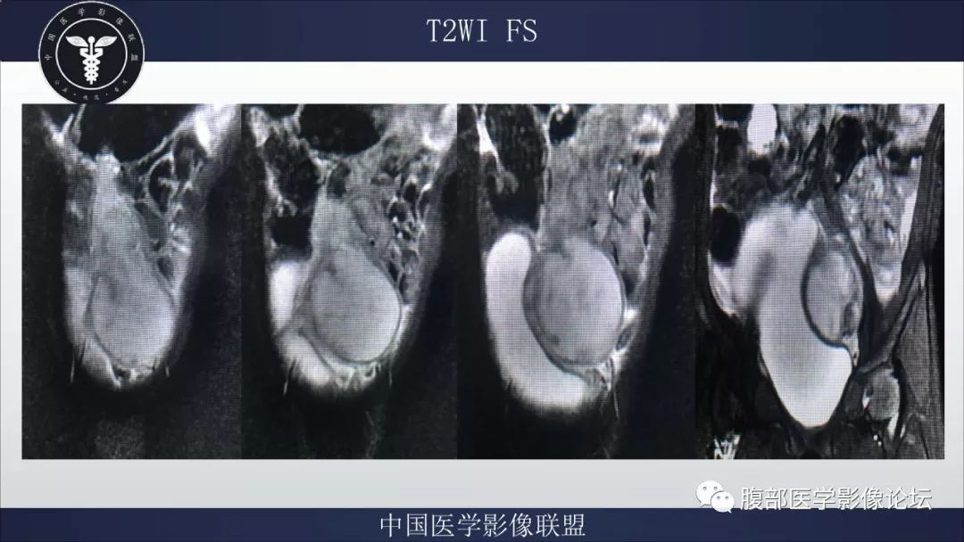 【病例】脐尿管囊肿并感染1例MR影像表现