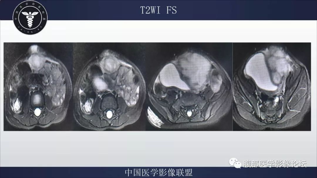 【病例】脐尿管囊肿并感染1例MR影像表现