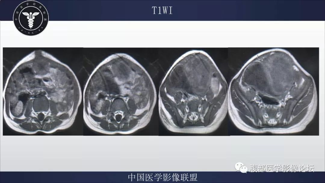 【病例】脐尿管囊肿并感染1例MR影像表现
