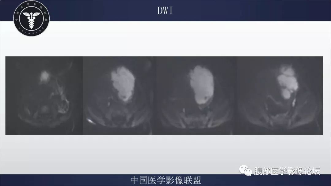 【病例】脐尿管囊肿并感染1例MR影像表现