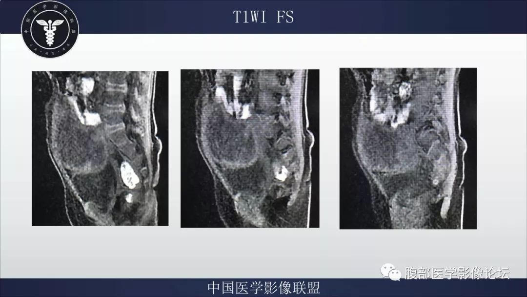 【病例】脐尿管囊肿并感染1例MR影像表现
