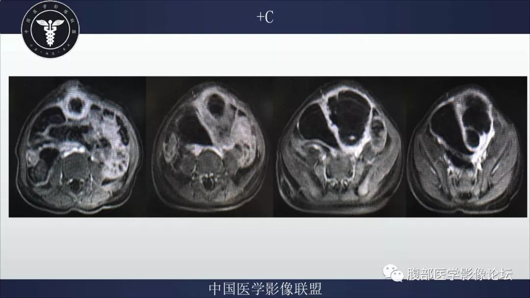 【病例】脐尿管囊肿并感染1例MR影像表现
