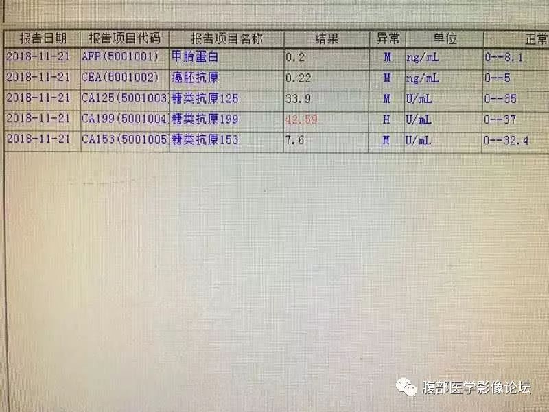 【病例】脐尿管囊肿并感染1例MR影像表现
