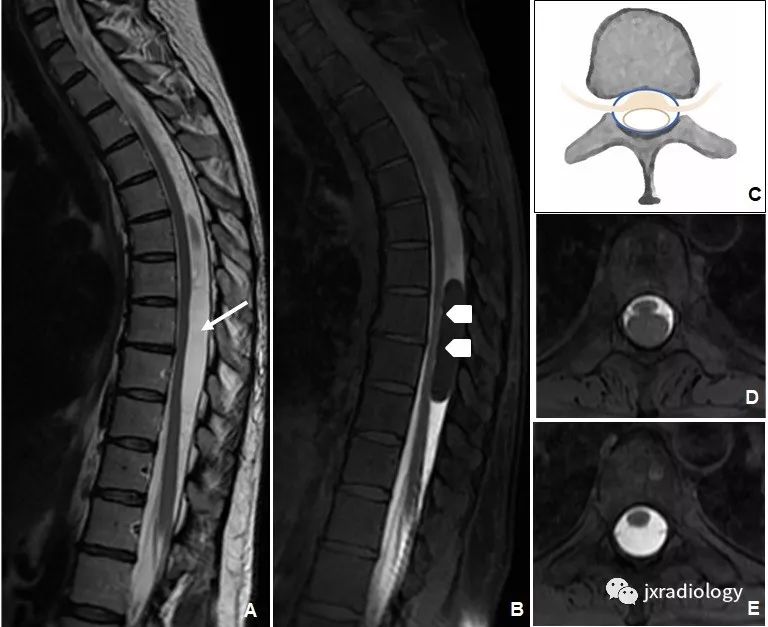椎管内囊性病变的分类和影像诊断 椎管内囊性病变的分类和影像诊断