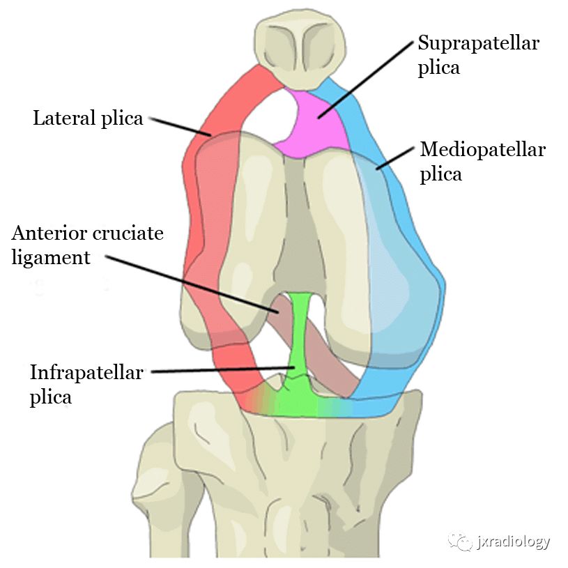 髌内侧滑膜皱襞综合征(Medial patellar plica syndrome, MPS) 髌内侧滑膜皱襞综合征(Medial patellar plica syndrome, MPS)