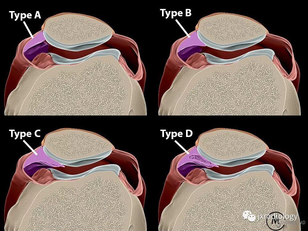 髌内侧滑膜皱襞综合征(Medial patellar plica syndrome, MPS) 髌内侧滑膜皱襞综合征(Medial patellar plica syndrome, MPS)