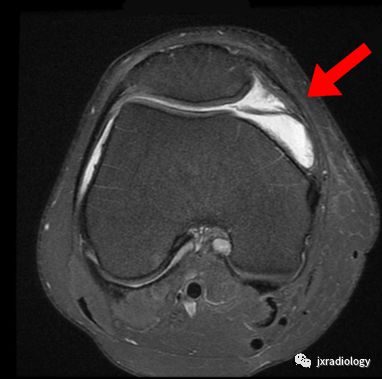 髌内侧滑膜皱襞综合征(Medial patellar plica syndrome, MPS) 髌内侧滑膜皱襞综合征(Medial patellar plica syndrome, MPS)
