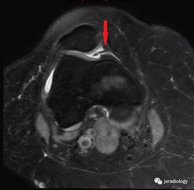 髌内侧滑膜皱襞综合征(Medial patellar plica syndrome, MPS) 髌内侧滑膜皱襞综合征(Medial patellar plica syndrome, MPS)