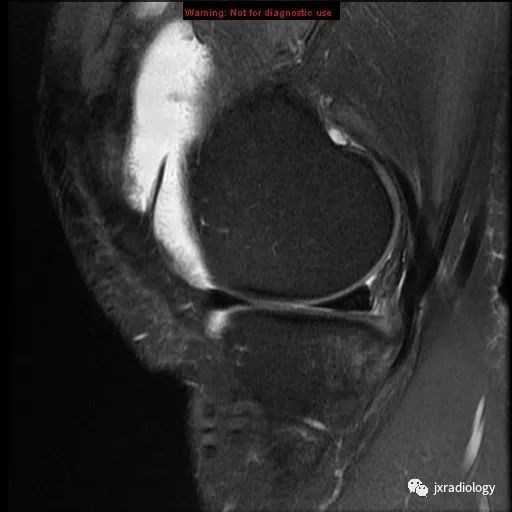 髌内侧滑膜皱襞综合征(Medial patellar plica syndrome, MPS) 髌内侧滑膜皱襞综合征(Medial patellar plica syndrome, MPS)