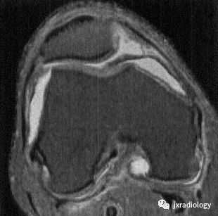 髌内侧滑膜皱襞综合征(Medial patellar plica syndrome, MPS) 髌内侧滑膜皱襞综合征(Medial patellar plica syndrome, MPS)
