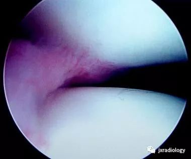 髌内侧滑膜皱襞综合征(Medial patellar plica syndrome, MPS) 髌内侧滑膜皱襞综合征(Medial patellar plica syndrome, MPS)