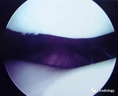 髌内侧滑膜皱襞综合征(Medial patellar plica syndrome, MPS) 髌内侧滑膜皱襞综合征(Medial patellar plica syndrome, MPS)