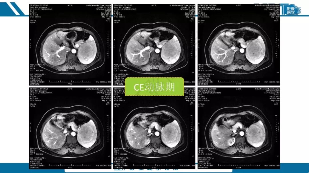 【病例】脾脏错构瘤1例病例解析