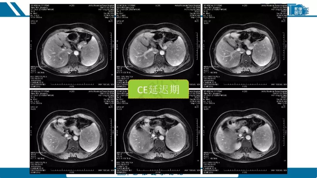 【病例】脾脏错构瘤1例病例解析