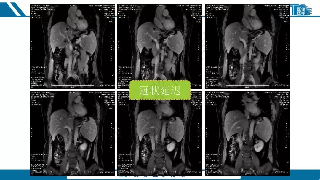【病例】脾脏错构瘤1例病例解析