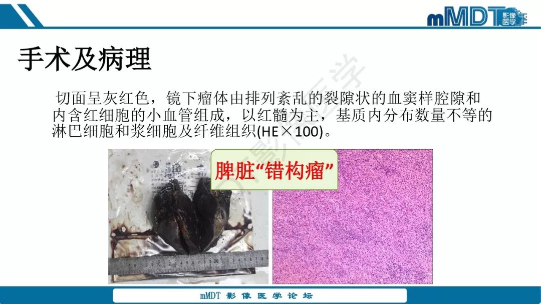 【病例】脾脏错构瘤1例病例解析