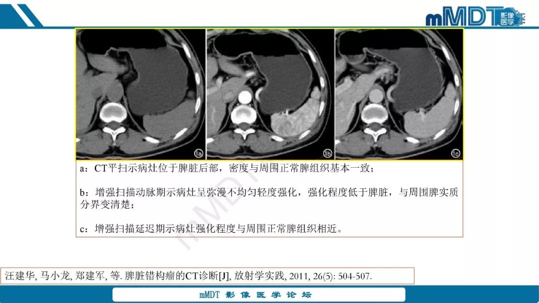 【病例】脾脏错构瘤1例病例解析
