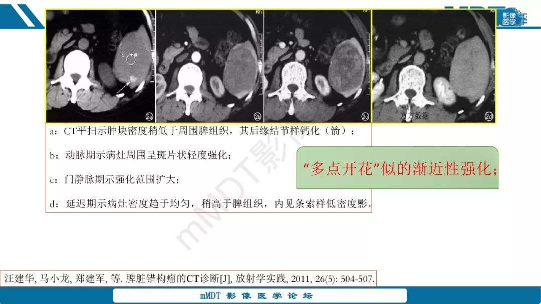 【病例】脾脏错构瘤1例病例解析