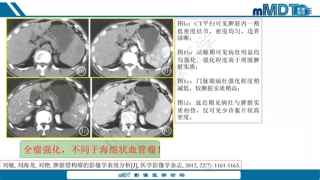 【病例】脾脏错构瘤1例病例解析