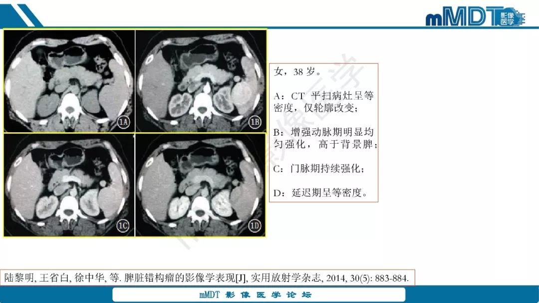 【病例】脾脏错构瘤1例病例解析