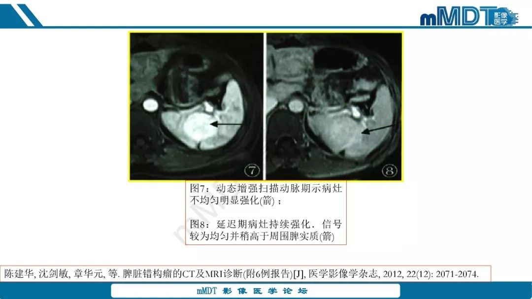 【病例】脾脏错构瘤1例病例解析