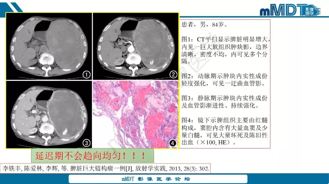 【病例】脾脏错构瘤1例病例解析