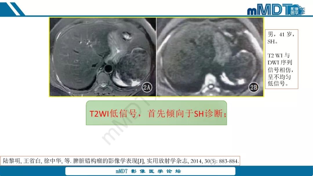 【病例】脾脏错构瘤1例病例解析