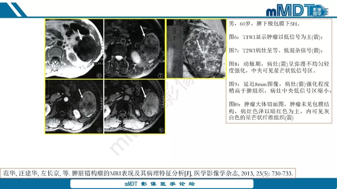 【病例】脾脏错构瘤1例病例解析