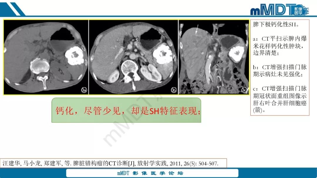 【病例】脾脏错构瘤1例病例解析