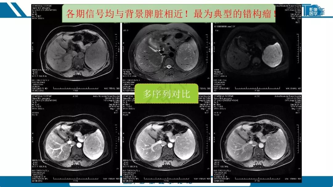 【病例】脾脏错构瘤1例病例解析
